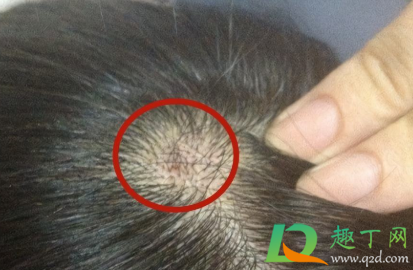 后脑勺头皮长疙瘩是什么原因(后脑勺头皮长很多疙瘩)
