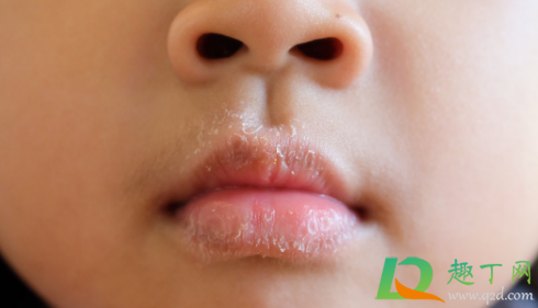 嘴唇干是怎么回事(嘴唇干是怎么回事吃什么药)