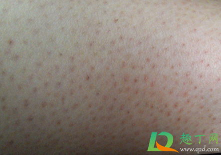 毛囊炎的图片是什么样子的(毛囊炎是什么样子的图片库) 毛囊炎的图片是什么样子的(毛囊炎是什么样子的图片库)