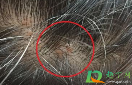 后脑勺头皮长疙瘩是什么原因(后脑勺头皮长很多疙瘩)