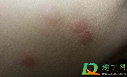 床虫咬了很痒怎么止痒(床上有虫子咬人很痒怎么办怎样消灭)