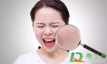 湿气重有什么症状会长痘吗(湿气重为什么会长痘)