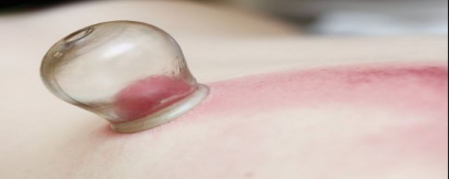 拔火罐的好处与坏处有哪些?(拔火罐有没有好处和坏处)