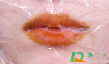 嘴起泡快速消除小窍门用什么药最好(嘴起泡快速消除小偏方)