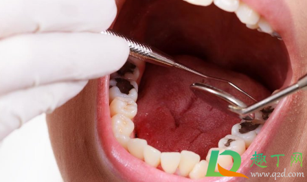 带牙套吃东西老塞在牙套里怎么办 带牙套吃东西老塞在牙套里怎么办