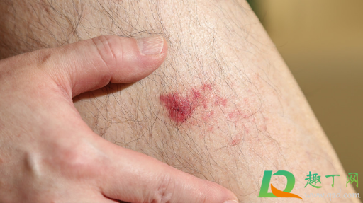 热油烫伤的红印会自动好吗(被热油烫伤后红印多久能消退)