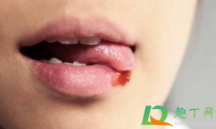 嘴起泡快速消除小窍门用什么药最好(嘴起泡快速消除小偏方)