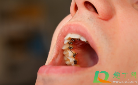 带牙套是不是要把牙齿磨掉一半(磨牙会不会把牙套磨掉)