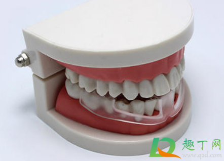 带牙套一般带多少年(戴牙套要带多少年)