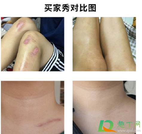 敖东祛疤膏好用吗(敖东祛疤膏老疤可以用吗)