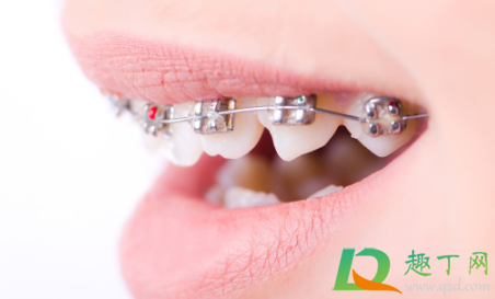 带牙套是先拔牙还是后拔牙(为什么先带牙套后拔牙)