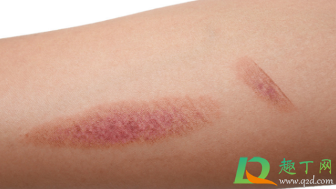 被油烫伤留疤还能去掉吗(油烫伤留疤怎么能去掉) 被油烫伤留疤还能去掉吗(油烫伤留疤怎么能去掉)