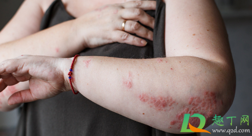 热油烫伤的红印会自动好吗(被热油烫伤后红印多久能消退) 热油烫伤的红印会自动好吗(被热油烫伤后红印多久能消退)