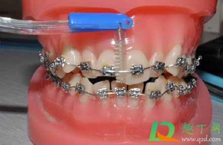 带牙套一般带多少年(戴牙套要带多少年)