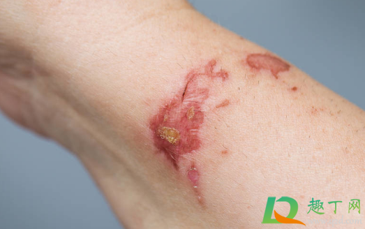 热油烫伤的红印会自动好吗(被热油烫伤后红印多久能消退) 热油烫伤的红印会自动好吗(被热油烫伤后红印多久能消退)