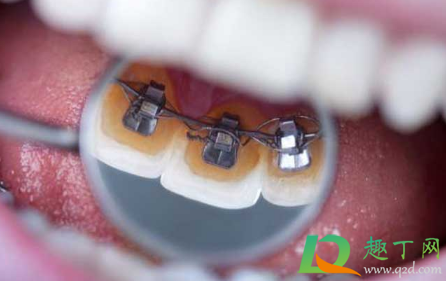 带牙套是不是要把牙齿磨掉一半(磨牙会不会把牙套磨掉) 带牙套是不是要把牙齿磨掉一半(磨牙会不会把牙套磨掉)