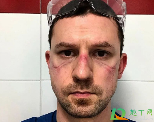 泳镜太紧勒出印子咋办(泳镜带完为什么勒痕这么深) 泳镜太紧勒出印子咋办(泳镜带完为什么勒痕这么深)