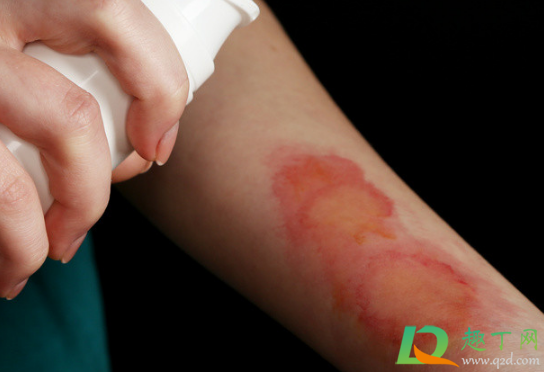 开水烫伤怎么办(水被开水烫伤怎么办) 开水烫伤怎么办(水被开水烫伤怎么办)