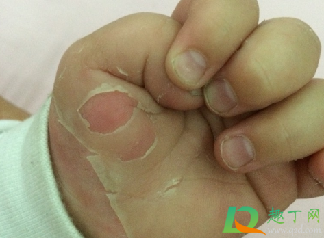 儿童手掌脱皮是怎么回事(小孩手掌脱皮是什么原因呢)