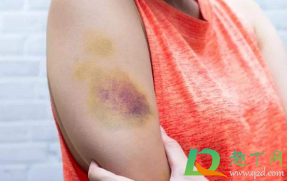 棍子打的红肿紫怎么消(棍子打肿起来怎么消肿) 棍子打的红肿紫怎么消(棍子打肿起来怎么消肿)