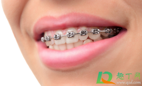 带牙套的年龄有限制吗(年纪多大不可以带牙套)