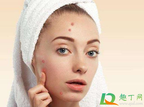 三角部位的痘挤破感染怎么办(不小心挤破了危险三角区的痘痘怎么办) 三角部位的痘挤破感染怎么办(不小心挤破了危险三角区的痘痘怎么办)