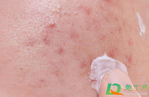 鼻子上长脓包型痘痘怎么办 鼻子上长脓包型痘痘怎么办