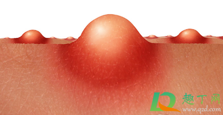 挤痘痘造成颅内感染几率大吗(挤痘痘很容易颅内感染吗)