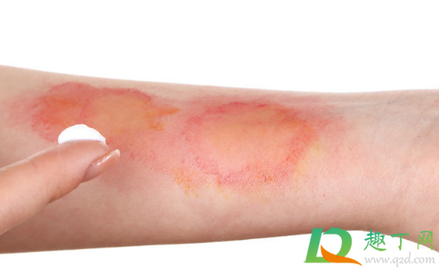 烫伤用什么药(烫伤用什么药好得快一点)