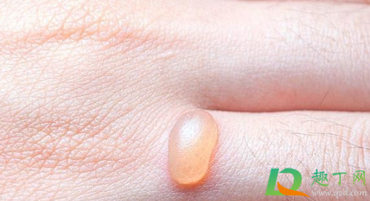 手被蒸汽烫伤能抹牙膏不(手被热气烫伤可以用牙膏敷吗)