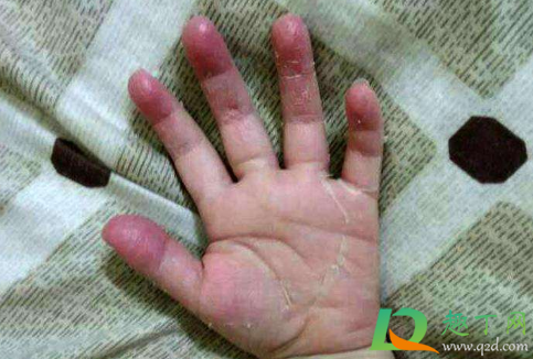 儿童手掌脱皮是怎么回事(小孩手掌脱皮是什么原因呢)