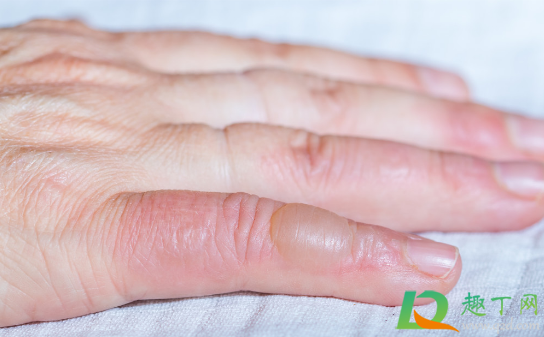 手被蒸汽烫伤能抹牙膏不(手被热气烫伤可以用牙膏敷吗)