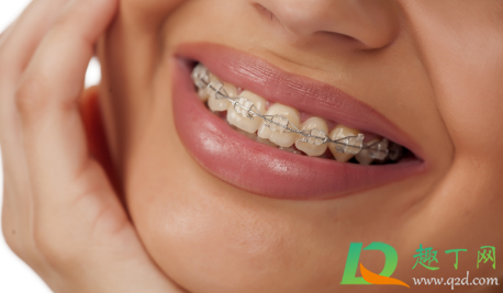 带牙套的年龄有限制吗(年纪多大不可以带牙套)