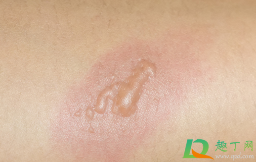 蒸汽烫伤能用凉水冲吗(开水或蒸汽烫伤后能不能用自来水冲洗)