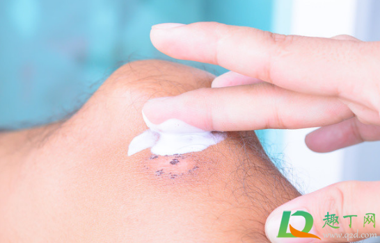 烫伤不涂药会自动好吗(烫伤后不涂药皮肤会好吗)