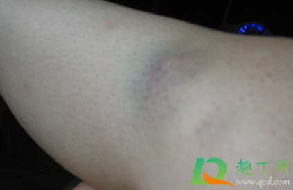 棍子打的红肿紫怎么消(棍子打肿起来怎么消肿)