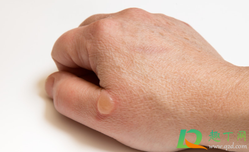 蒸汽烫伤能用凉水冲吗(开水或蒸汽烫伤后能不能用自来水冲洗)