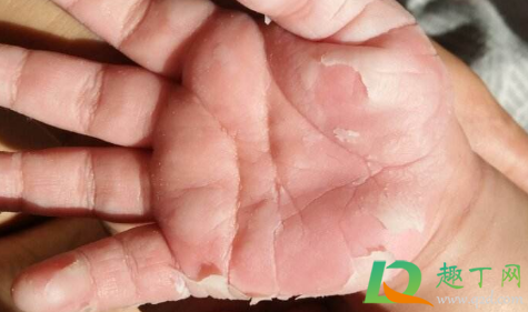 儿童手掌脱皮是怎么回事(小孩手掌脱皮是什么原因呢)