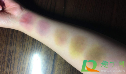 棍子打的红肿紫怎么消(棍子打肿起来怎么消肿) 棍子打的红肿紫怎么消(棍子打肿起来怎么消肿)