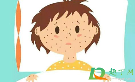 水痘打过针还会感染吗(打了水痘针还会出吗)