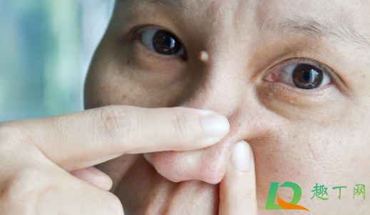 鼻子上长脓包型痘痘怎么办 鼻子上长脓包型痘痘怎么办