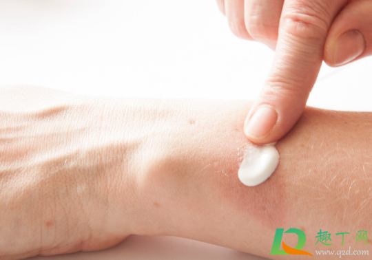 烫伤不涂药会自动好吗(烫伤后不涂药皮肤会好吗)