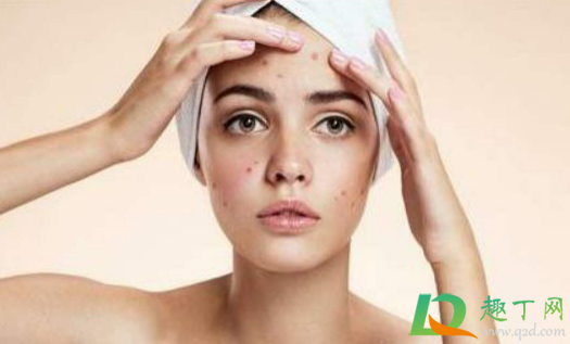 三角部位的痘挤破感染怎么办(不小心挤破了危险三角区的痘痘怎么办) 三角部位的痘挤破感染怎么办(不小心挤破了危险三角区的痘痘怎么办)