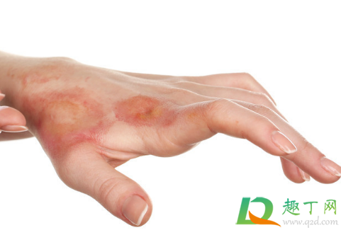 烫伤用什么药(烫伤用什么药好得快一点)