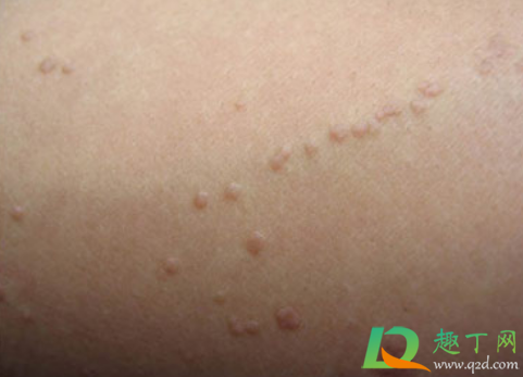 脖子上长小肉粒是什么原因(男性脖子上长小肉粒是什么原因)