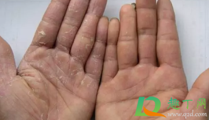 手上长小水泡还痒怎么回事会传染吗(手上长了好多小水泡特别痒怎么办会传染吗) 手上长小水泡还痒怎么回事会传染吗(手上长了好多小水泡特别痒怎么办会传染吗)