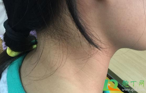 脖子上长小肉粒是什么原因(男性脖子上长小肉粒是什么原因) 脖子上长小肉粒是什么原因(男性脖子上长小肉粒是什么原因)