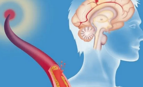 脑梗拍打三天见奇效真的假的