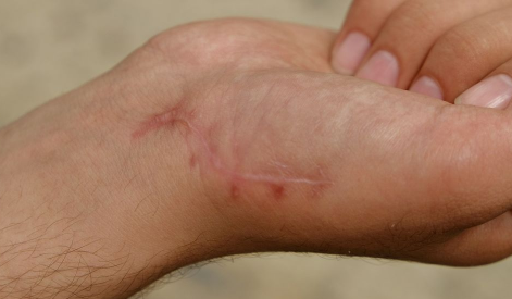 蚊子咬了消肿慢是什么原因(被蚊子咬了很快就消肿了的人的体质)