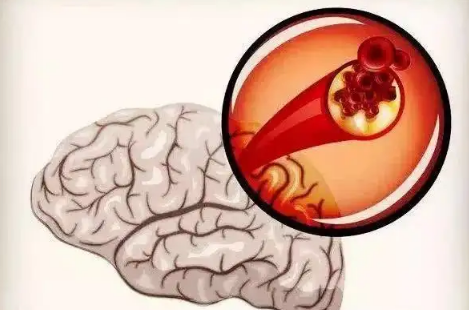 脑梗拍打三天见奇效真的假的